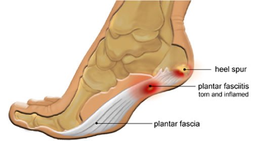 Plantar Fasciitis vs. Heel Spurs